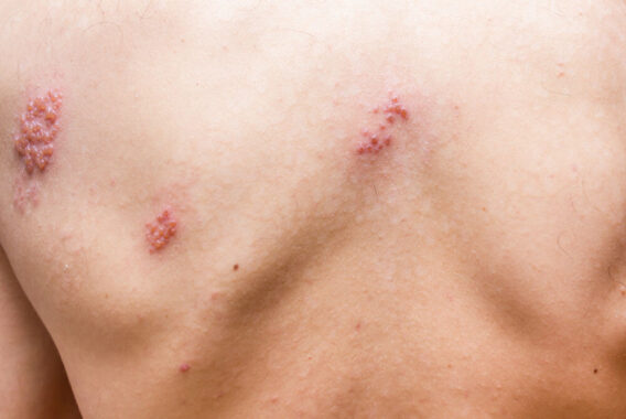 Can I Still Get Shingles (Herpes Zoster) if I Had Chicken Pox?